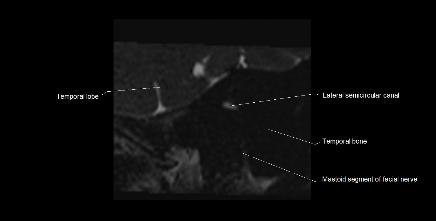Internal auditory meatus (IAM) 3T sagittal cross sectional anatomy image 1.webp